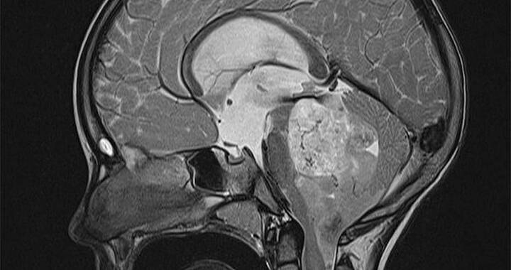 MRT-Bild von einem menschlichen Gehirn mit erkennbarem helleren Tumor.