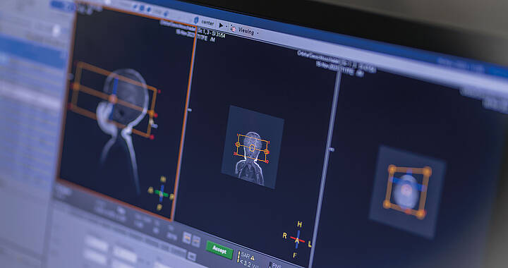 Computerbildschirm mit detaillierter medizinischer 3D-Abbildung eines menschlichen Kopfes mit verschiedenen Maßanmerkungen.